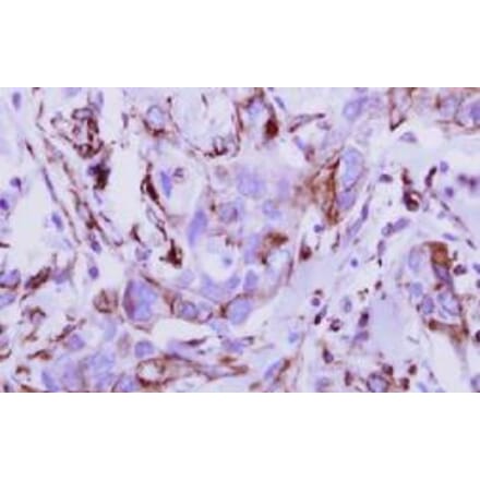 Immunohistochemical analysis - breast cancer - Antibodies.com