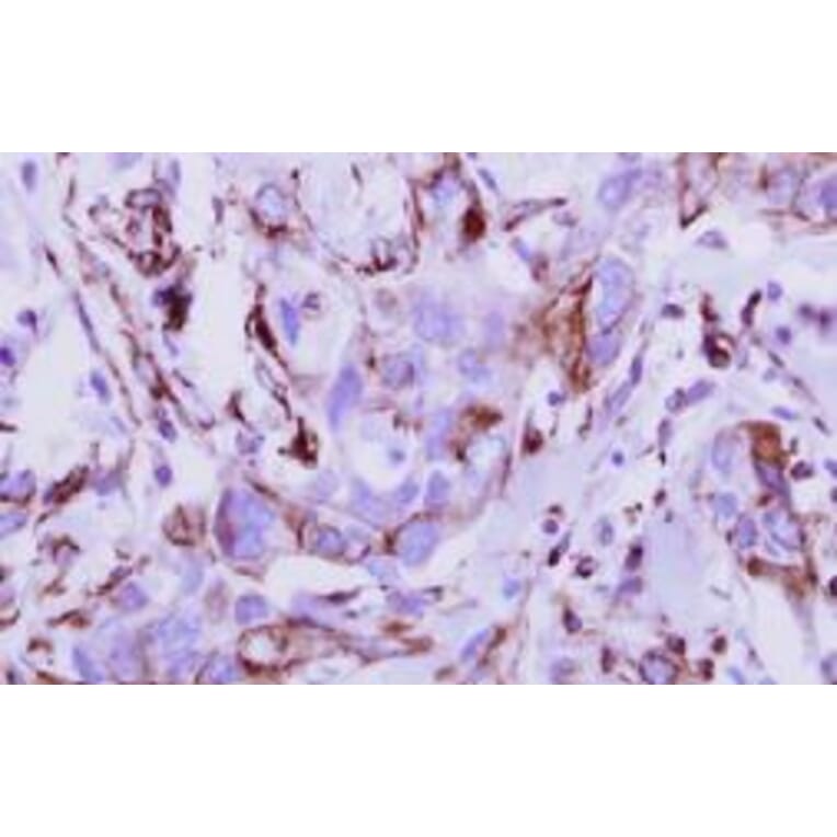 Immunohistochemical analysis - breast cancer - Antibodies.com