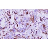 Immunohistochemical analysis - breast cancer - Antibodies.com