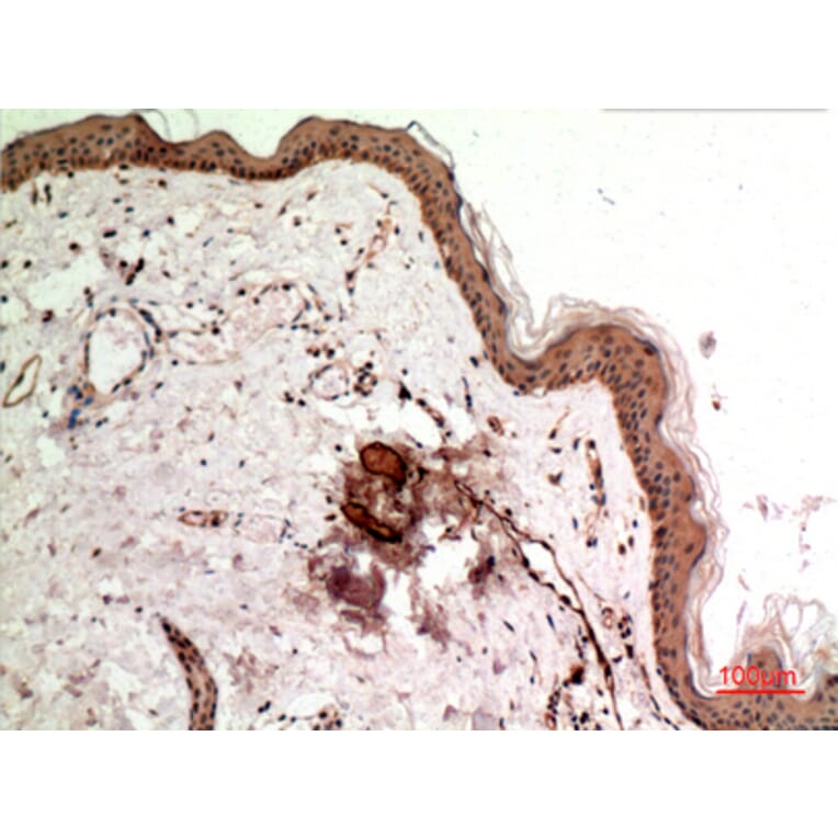 Immunohistochemistry - Anti-SSX1 + 2 + 3 + 4 + 5 + 6 + 7 + 8 + 9 Antibody (C30110) - Antibodies.com