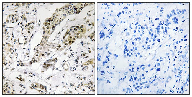 Immunohistochemical analysis of paraffin-embedded human breast carcinoma using Anti-TCEAL3 + TCEAL5 + TCEAL6 Antibody. The right hand panel represents a negative control, where the antibody was pre-incubated with the immunising peptide.