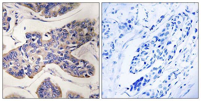 Immunohistochemical analysis of paraffin-embedded human breast carcinoma tissue using Anti-TAOK1 Antibody. The right hand panel represents a negative control, where the antibody was pre-incubated with the immunising peptide.