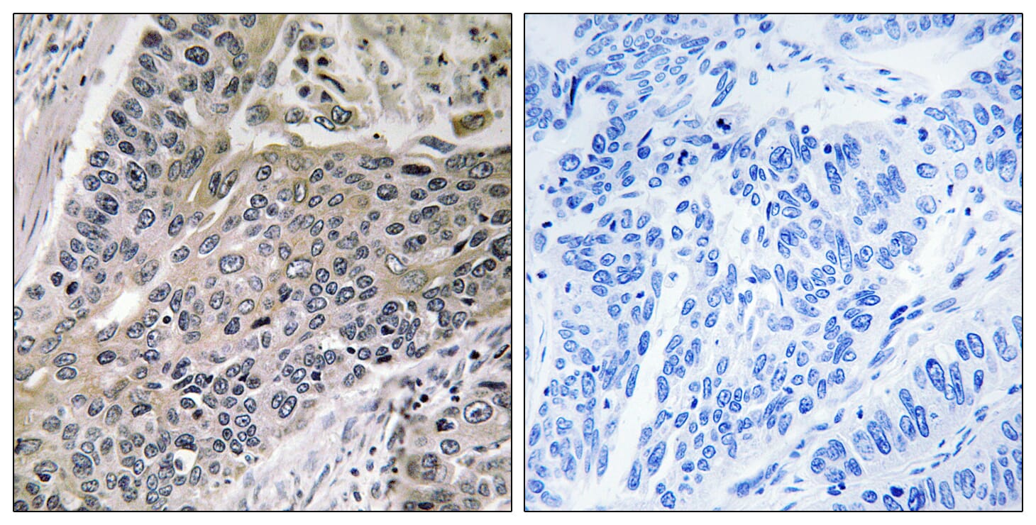 Immunohistochemical analysis of paraffin-embedded human lung carcinoma tissue using Anti-MRPS7 Antibody. The right hand panel represents a negative control, where the antibody was pre-incubated with the immunising peptide.