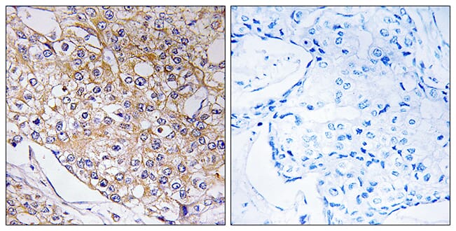 Immunohistochemical analysis of paraffin-embedded human breast carcinoma tissue using Anti-TRAPPC1 Antibody. The right hand panel represents a negative control, where the antibody was pre-incubated with the immunising peptide.