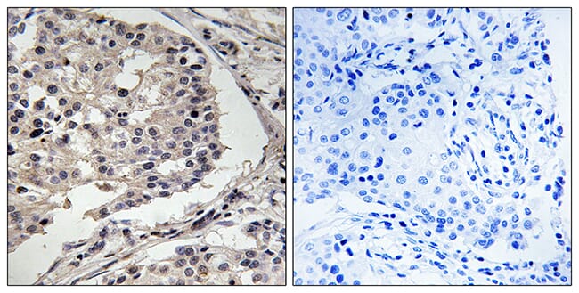 Immunohistochemical analysis of paraffin-embedded human breast carcinoma tissue using Anti-MLK1 + MLK2 Antibody. The right hand panel represents a negative control, where the antibody was pre-incubated with the immunising peptide.