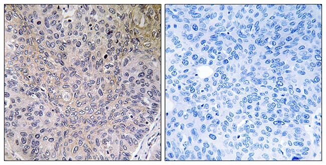 Immunohistochemical analysis of paraffin-embedded human lung carcinoma tissue using Anti-NDUFS7 Antibody. The right hand panel represents a negative control, where the antibody was pre-incubated with the immunising peptide.