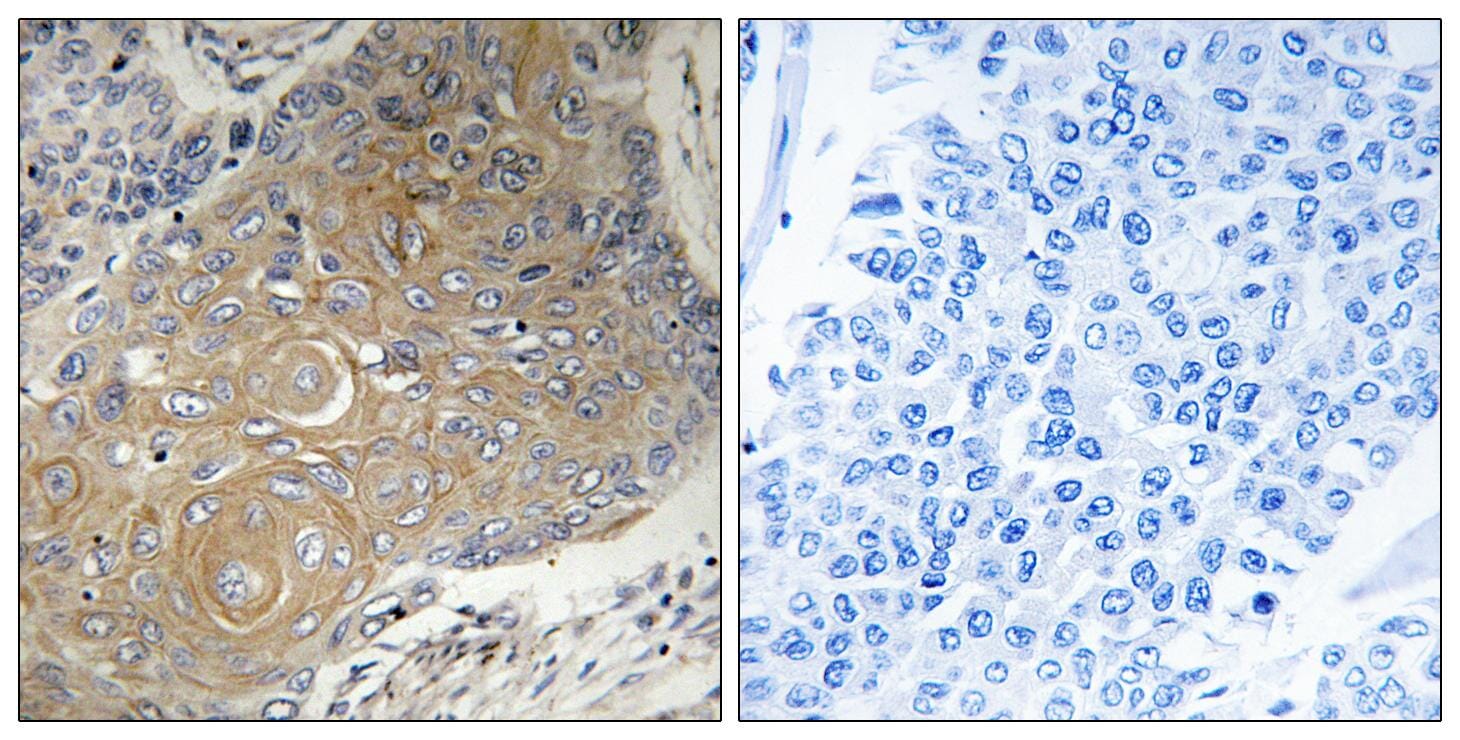 Immunohistochemical analysis of paraffin-embedded human lung carcinoma tissue using Anti-MRPS33 Antibody. The right hand panel represents a negative control, where the antibody was pre-incubated with the immunising peptide.