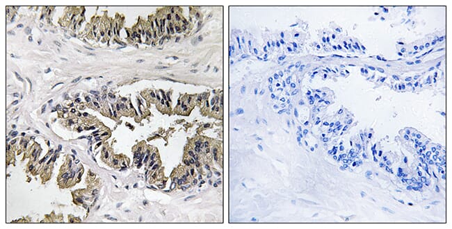 Immunohistochemical analysis of paraffin-embedded human prostate carcinoma tissue using Anti-GSPT1 Antibody. The right hand panel represents a negative control, where the antibody was pre-incubated with the immunising peptide.