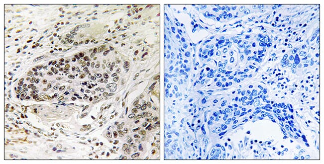 Immunohistochemical analysis of paraffin-embedded human lung carcinoma tissue using Anti-APBA2 Antibody. The right hand panel represents a negative control, where the antibody was pre-incubated with the immunising peptide.