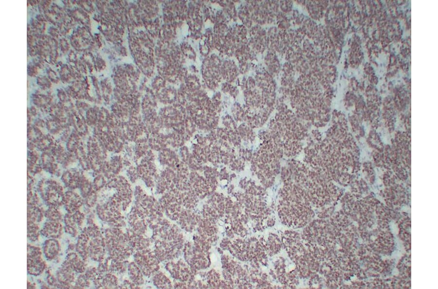 Immunohistochemistry - Anti-Wilms' Tumor 1 Antibody (V0140) - Antibodies.com