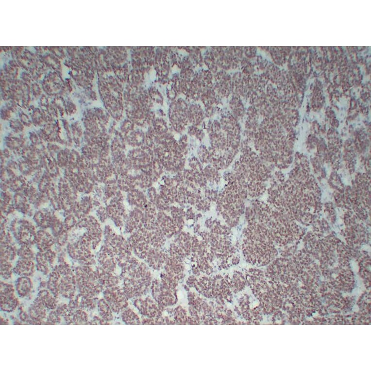 Immunohistochemistry - Anti-Wilms' Tumor 1 Antibody (V0140) - Antibodies.com
