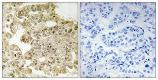 Immunohistochemical analysis of paraffin-embedded human breast cancer using Anti-EIF5B Antibody 1:100 (4°C overnight). The right hand panel represents a negative control, where the antibody was pre-incubated with the immunising peptide.