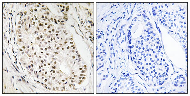 Immunohistochemical analysis of paraffin-embedded human breast carcinoma tissue using Anti-HNRNPUL2 Antibody. The right hand panel represents a negative control, where the antibody was pre-incubated with the immunising peptide.