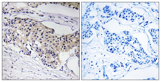 Immunohistochemical analysis of paraffin-embedded human breast carcinoma tissue using Anti-NDUFA3 Antibody. The right hand panel represents a negative control, where the antibody was pre-incubated with the immunising peptide.