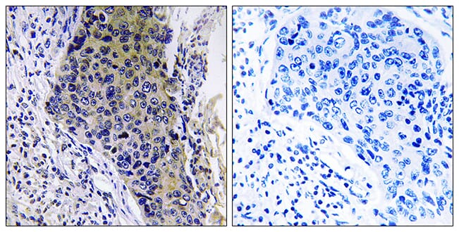 Immunohistochemical analysis of paraffin-embedded human lung carcinoma tissue using Anti-MRPL34 Antibody. The right hand panel represents a negative control, where the antibody was pre-incubated with the immunising peptide.