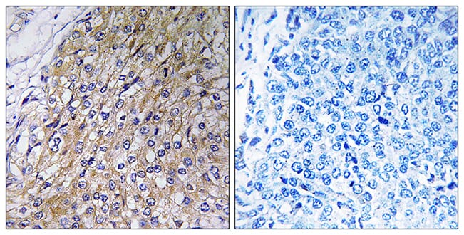Immunohistochemical analysis of paraffin-embedded human breast carcinoma tissue using Anti-GOLT1A Antibody. The right hand panel represents a negative control, where the antibody was pre-incubated with the immunising peptide.