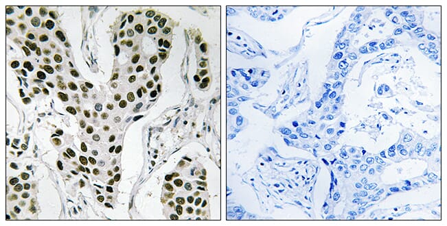 Immunohistochemical analysis of paraffin-embedded human breast carcinoma tissue using Anti-ZC3H4 Antibody. The right hand panel represents a negative control, where the antibody was pre-incubated with the immunising peptide.