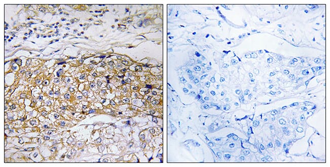 Immunohistochemical analysis of paraffin-embedded human breast carcinoma tissue using Anti-USP24 Antibody. The right hand panel represents a negative control, where the antibody was pre-incubated with the immunising peptide.