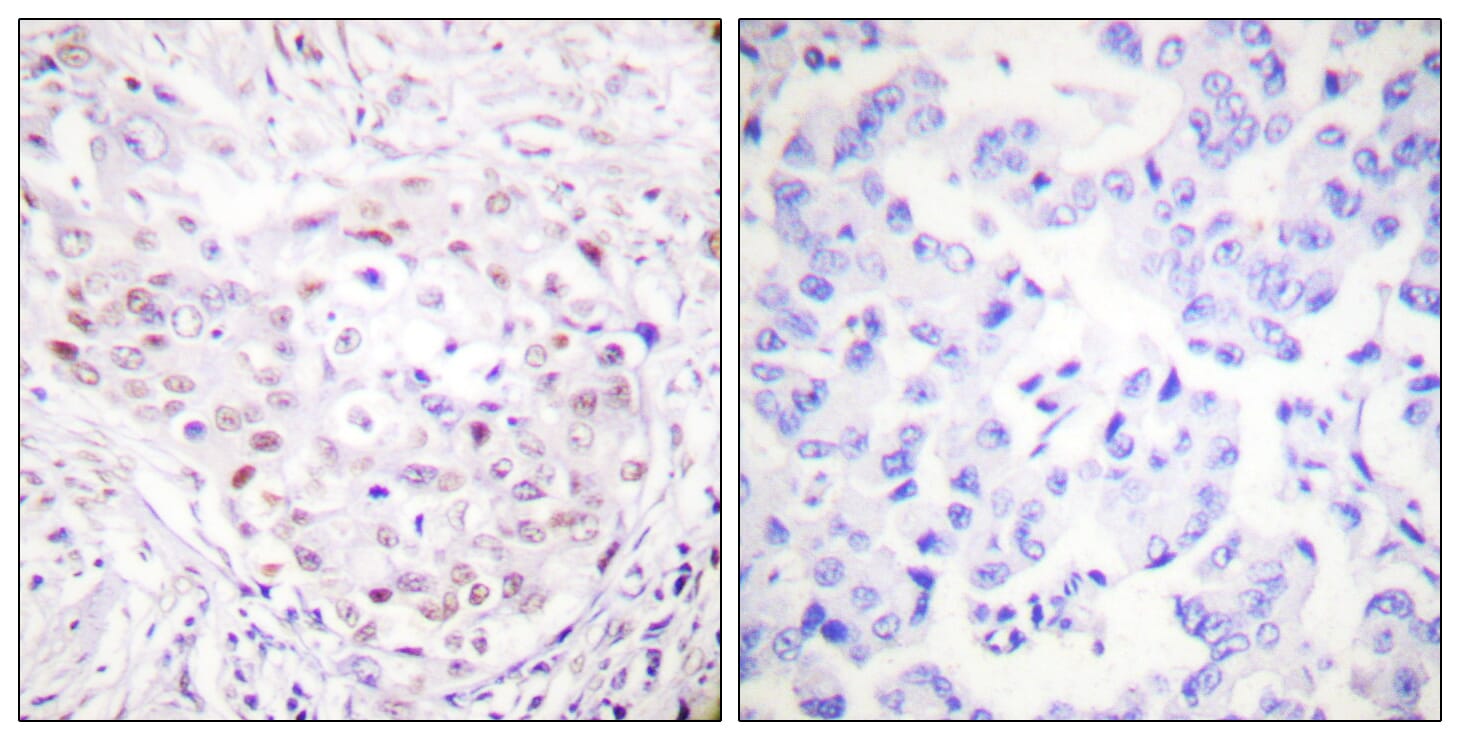 Immunohistochemical analysis of paraffin-embedded human breast carcinoma tissue using Anti-SENP3 Antibody. The right hand panel represents a negative control, where the antibody was pre-incubated with the immunising peptide.