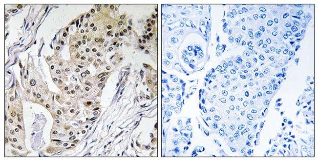 Immunohistochemical analysis of paraffin-embedded human breast carcinoma tissue using Anti-POLE4 Antibody. The right hand panel represents a negative control, where the antibody was pre-incubated with the immunising peptide.