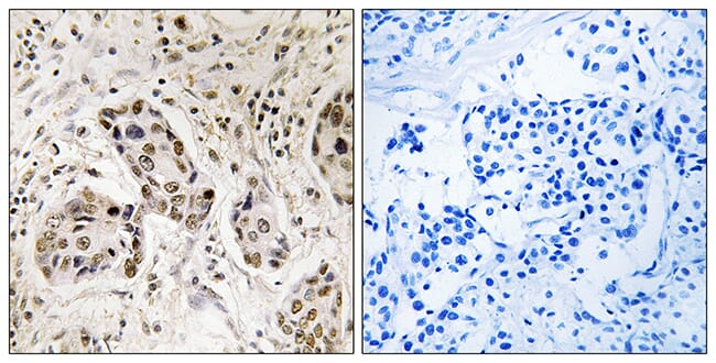 Immunohistochemical analysis of paraffin-embedded human breast carcinoma tissue using Anti-RCC2 Antibody. The right hand panel represents a negative control, where the antibody was pre-incubated with the immunising peptide.