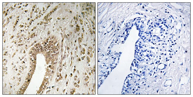 Immunohistochemical analysis of paraffin-embedded human breast carcinoma tissue using Anti-PHF3 Antibody. The right hand panel represents a negative control, where the antibody was pre-incubated with the immunising peptide.