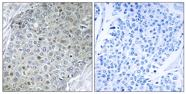 Immunohistochemical analysis of paraffin-embedded human breast carcinoma tissue using Anti-ETV4 Antibody. The right hand panel represents a negative control, where the antibody was pre-incubated with the immunising peptide.