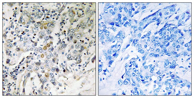Immunohistochemical analysis of paraffin-embedded human breast carcinoma tissue using Anti-ELL2 Antibody. The right hand panel represents a negative control, where the antibody was pre-incubated with the immunising peptide.