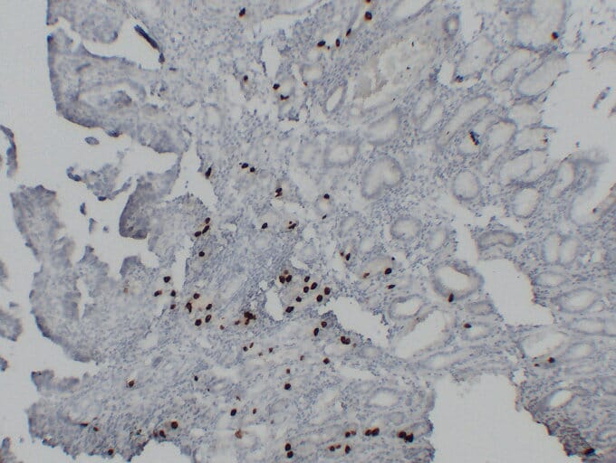 Immunohistochemical analysis of paraffin-embedded human Gastric adenocarcinoma using Anti-Gastrin Antibody.