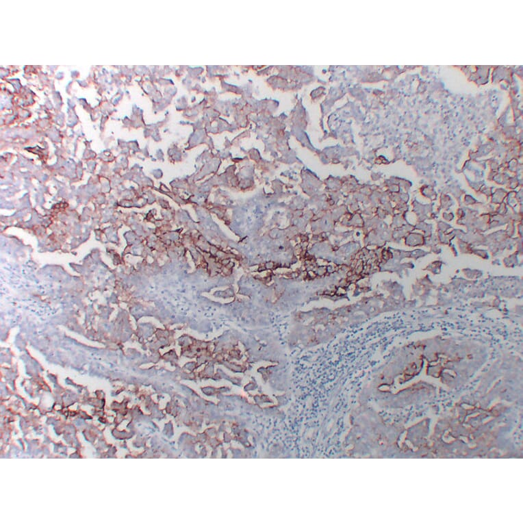 Immunohistochemistry - Anti-CA 125 Antibody (V0010) - Antibodies.com