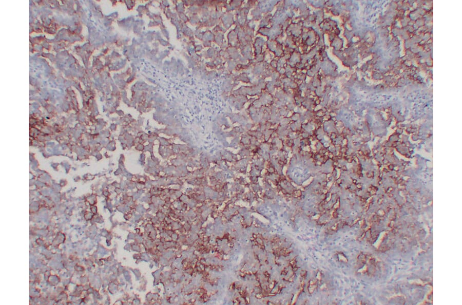 Immunohistochemistry - Anti-CA 125 Antibody (V0010) - Antibodies.com