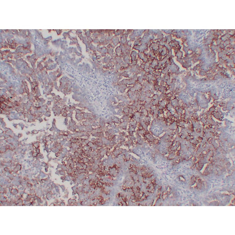 Immunohistochemistry - Anti-CA 125 Antibody (V0010) - Antibodies.com