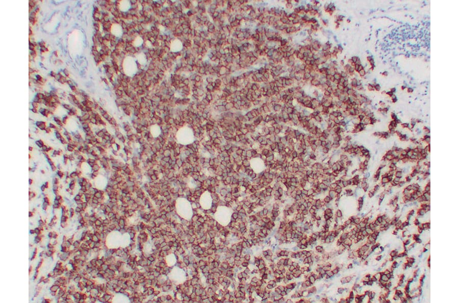 Immunohistochemistry - Anti-Her 2 Antibody (V0083) - Antibodies.com