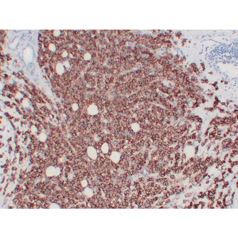 Immunohistochemistry - Anti-Her 2 Antibody (V0083) - Antibodies.com
