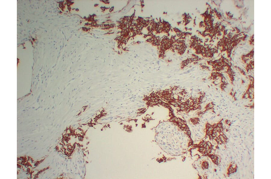 Immunohistochemistry - Anti-Her 2 Antibody (V0083) - Antibodies.com