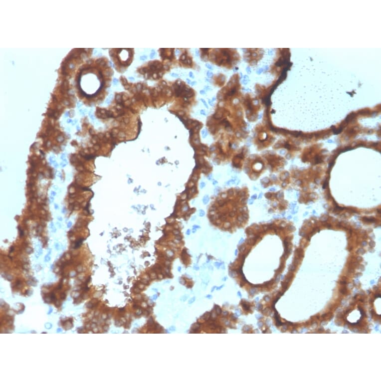 Influence Of Thyroid Peroxidase Antibodies On Tsh Levels Of Pregnant Women And Maternal Fetal Complications Endocrinologia Diabetes Y Nutricion English Ed