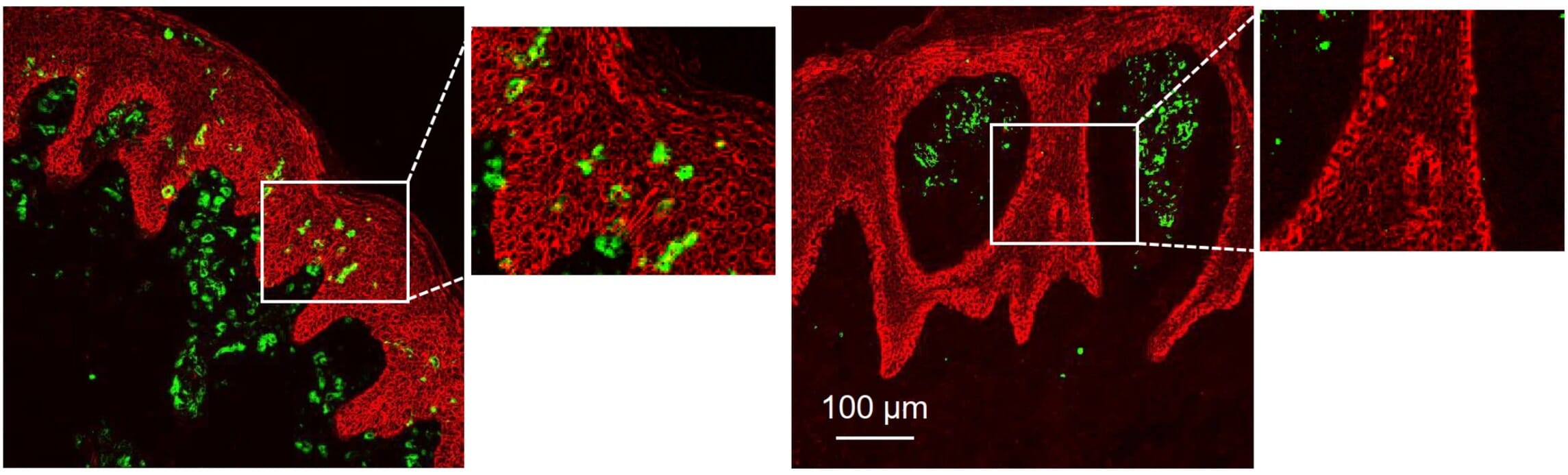 IHC of CD11c staining of human DCs in skin disease