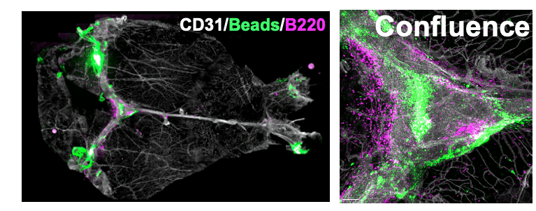 Fluorescence microscopy of dura mater wholemount from a childhood brain tumour-bearing mouse.